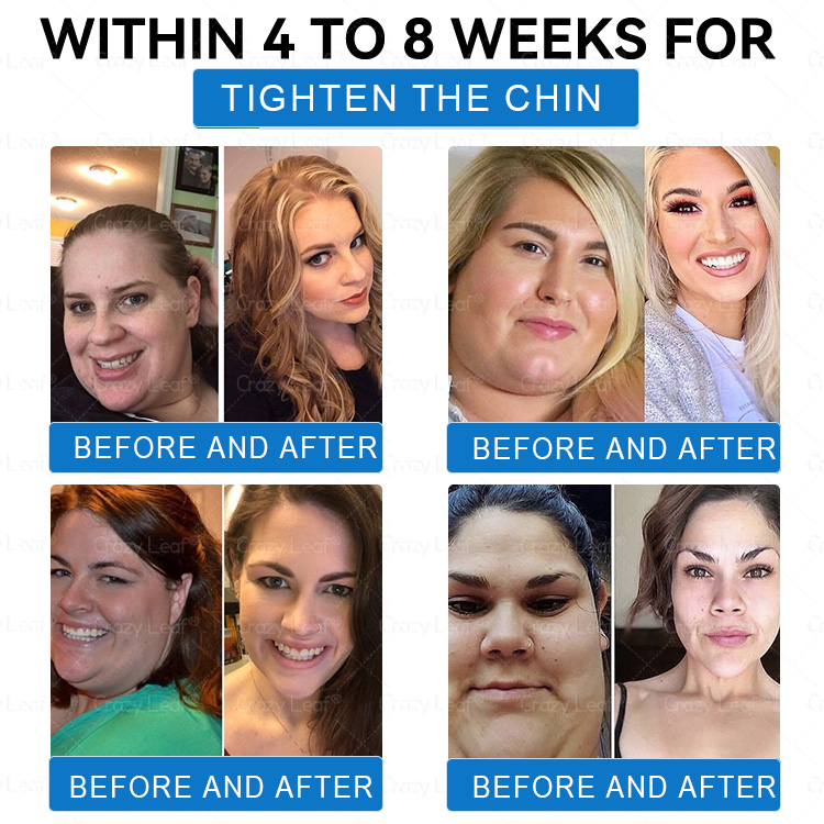 "Made & Shipped from Australia | Clinically Proven:CrazyLeaf® SMGT-GLP-1 Nano Microneedle Patch with Collagen & Matrixyl 3000 | Obesity,Cardiovascular Diseas, Diabetes, Sleep Apnea, Joint Problems and More"