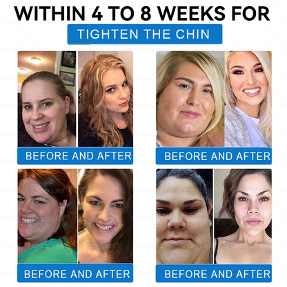 "Made & Shipped from Australia | Clinically Proven:CrazyLeaf® SMGT-GLP-1 Nano Microneedle Patch with Collagen & Matrixyl 3000 | Obesity,Cardiovascular Diseas, Diabetes, Sleep Apnea, Joint Problems and More"