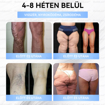 FDA Store | 𝐵uil𝗱𝐿ea𝐟® GLP-1 Slim & Firm Nano Microneedle Patch kollagénnel, kurkumával és Matrixyl 3000-rel | Elhízás, szív- és érrendszeri betegségek, cukorbetegség, alvási apnoe, ízületi problémák és egyéb állapotok kezelésére