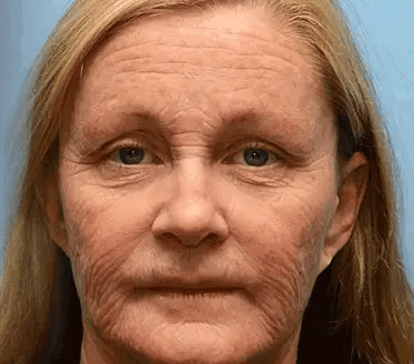 Mayo tisztviselő: AllyBee® bőrkezelő krém öregedésgátló, hidratáló, bőrjavító, egyenletes tónus, pattanások és sötét foltok kezelése, szemölcs és anyajegy eltávolítása, pikkelysömör enyhítése