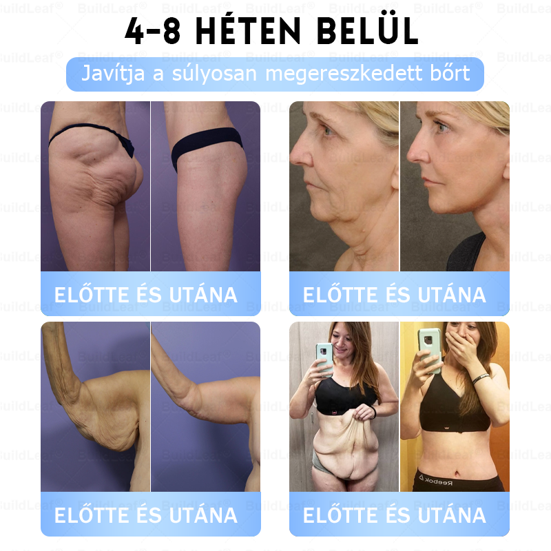 FDA Store | 𝐵uil𝗱𝐿ea𝐟® GLP-1 Slim & Firm Nano Microneedle Patch kollagénnel, kurkumával és Matrixyl 3000-rel | Elhízás, szív- és érrendszeri betegségek, cukorbetegség, alvási apnoe, ízületi problémák és egyéb állapotok kezelésére